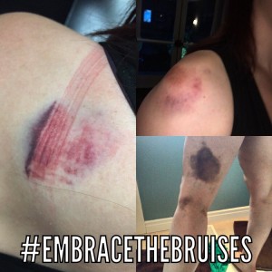 Embrace the Pole Bruises